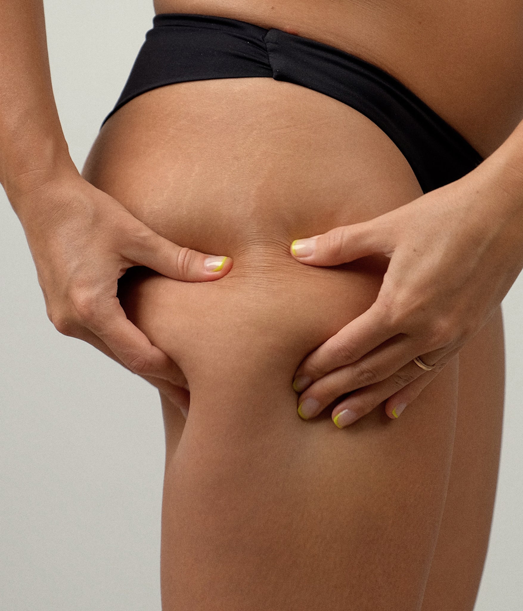 What are the different types of cellulite?
